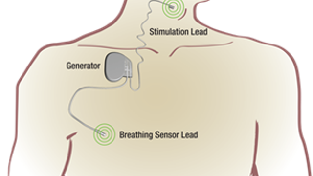 First FDA-approved implant for sleep apnea patients created in Minnesota