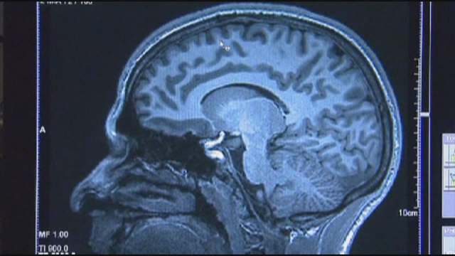 Doctors affirm 'concussions are not minor' after CDC releases new guidelines