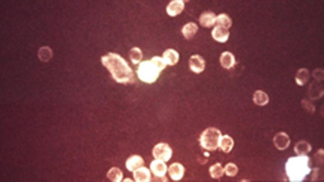 WHO: 3.7 billion people have herpes virus