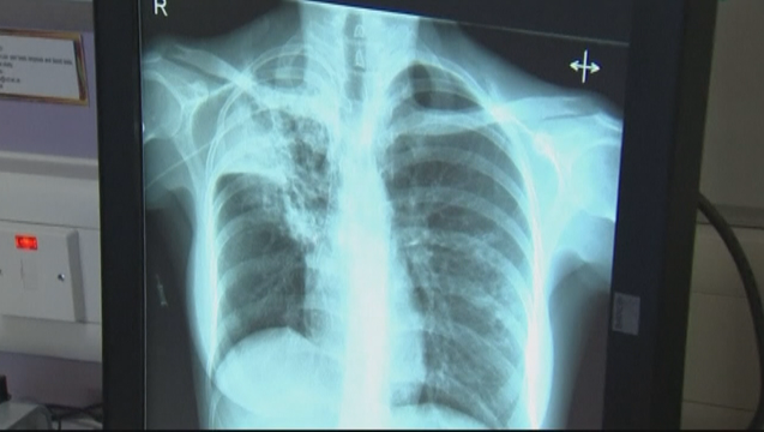 TUBERCULOSIS BROLL 2_KMSP93a1_146.mxf_00.01.00.06_1510023949352.png