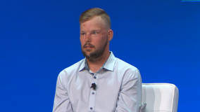 Man with facial transplant speaking out about his depression to help others