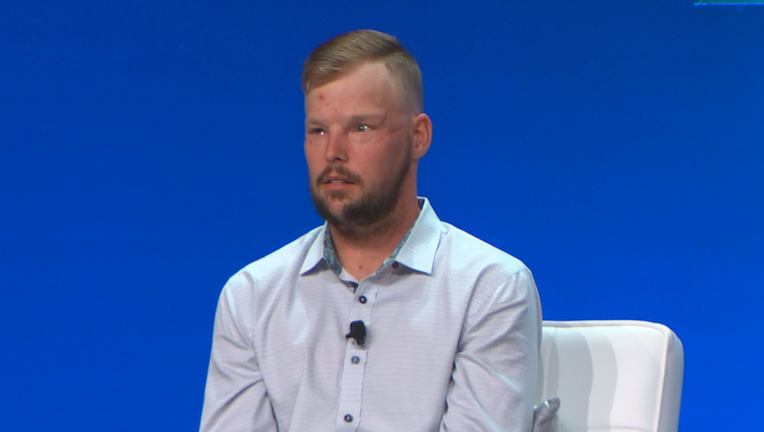 Facial transplant patient
