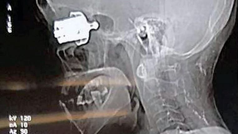 A scan shows the whistle lodged into the woman's skull.