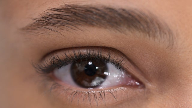 14 worms pulled from woman's eye after rare infection