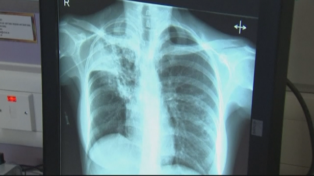 Tuberculosis outbreak in Ramsey County largest in country