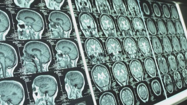 Study: Trainers report decrease in concussions during high school sports practices