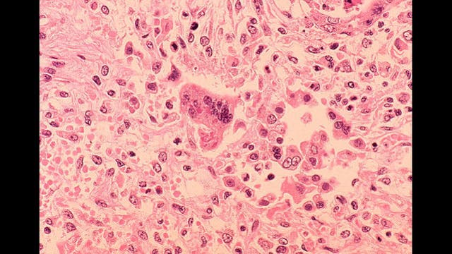 Authorities warn of potential measles exposure in western Wisconsin