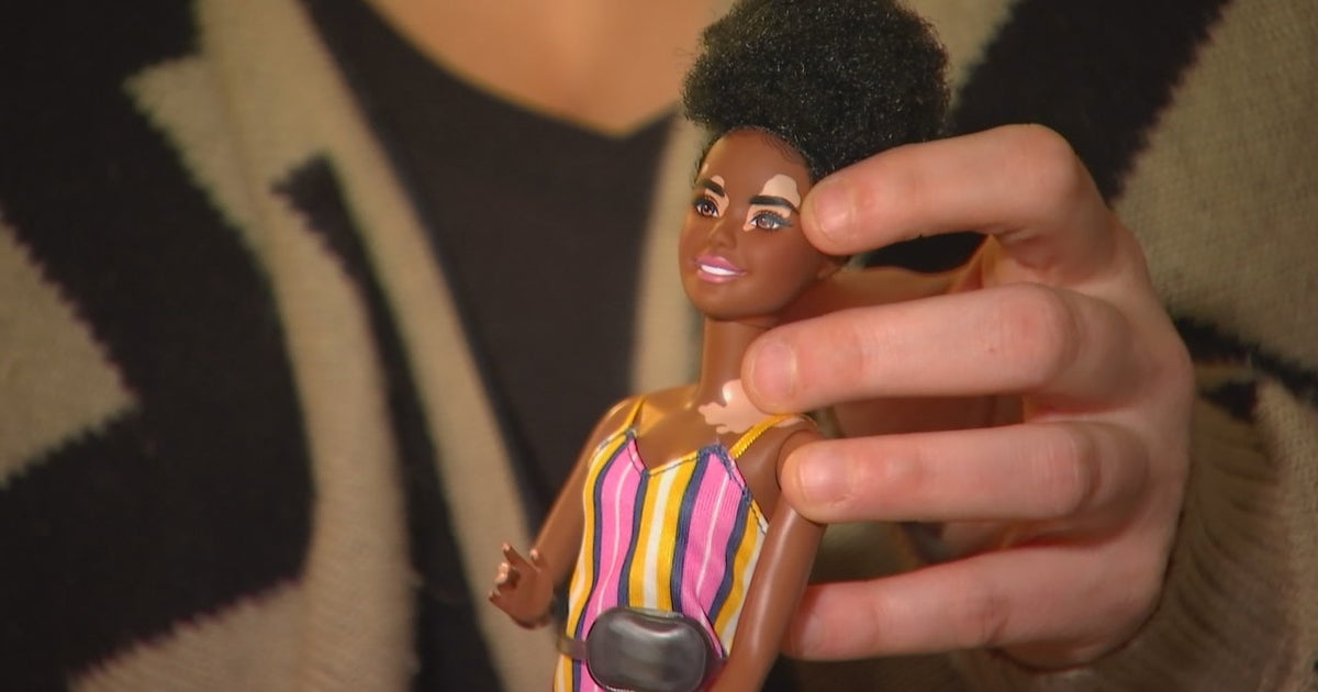 Barbies With Vitiligo Donated To Minnesota Vit Friends Support Group Barbies With Vitiligo Donated To Minnesota Vit Friends Support Group