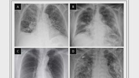 Researchers use artificial intelligence to detect COVID-19 in hospital patients