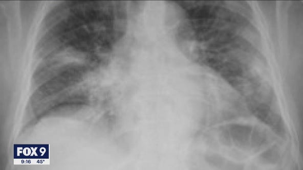 Researchers use artificial intelligence to detect COVID-19 in hospital patients