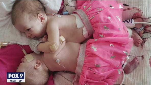Otsego family celebrates miracle after conjoined twins survive separation