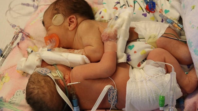 Otsego family celebrates miracle after conjoined twins survive separation