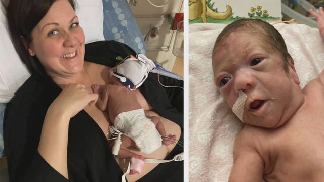 Kangaroo care: Newborn-mother bonding technique helps NICU baby grow