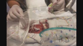 World's most premature baby, born in Minnesota, celebrates 1st birthday