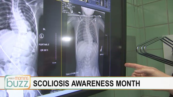 Spotting scoliosis in kids - what parents should be looking for