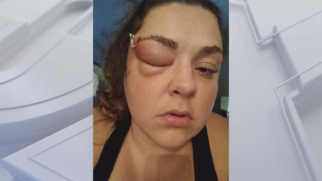Twin Cities woman says she contracted staph infection after visiting local salon