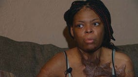 Woman set on fire by ex-boyfriend concerned he’ll get off easy on plea deal