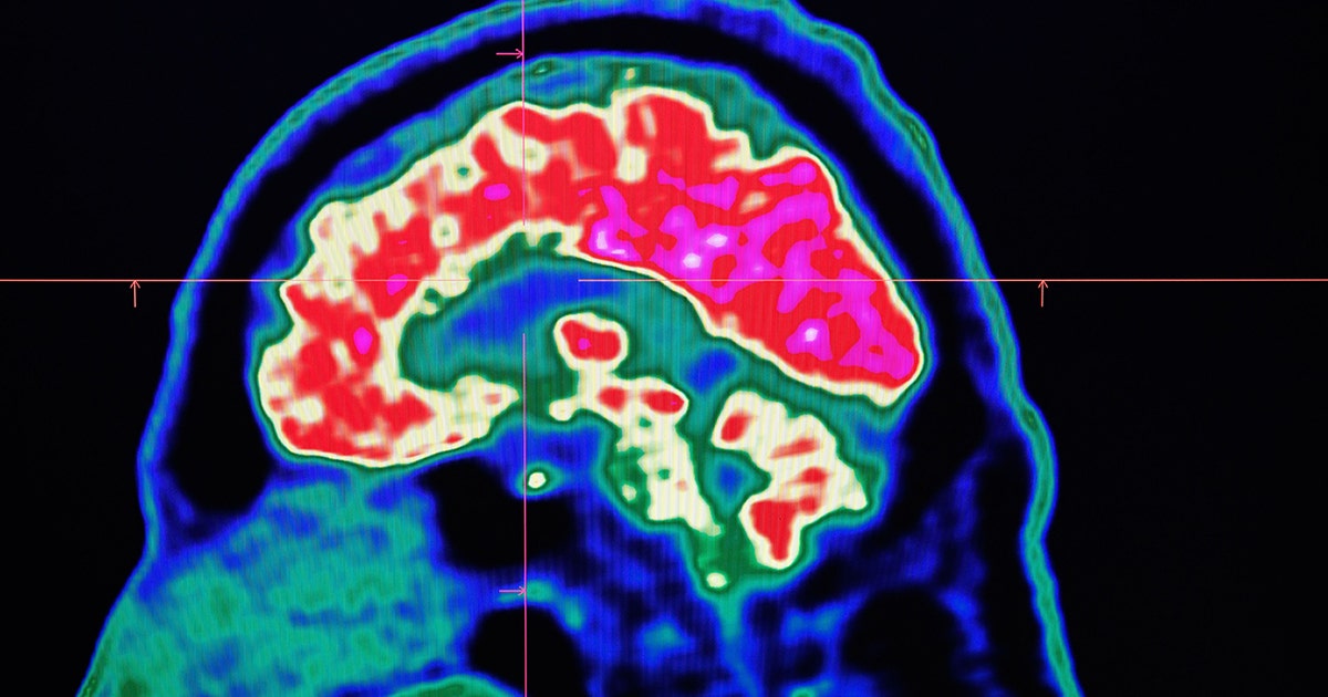 brain1.jpg?ve=1&tl=1