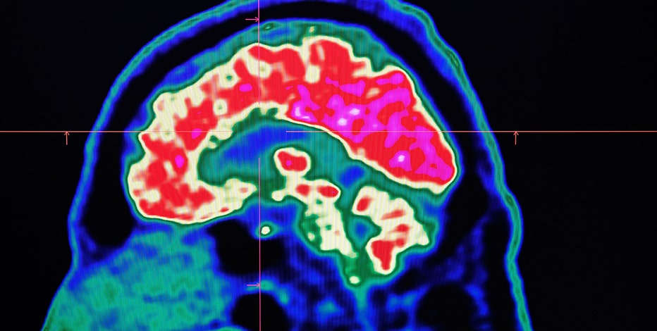brain1.jpg?ve=1&tl=1
