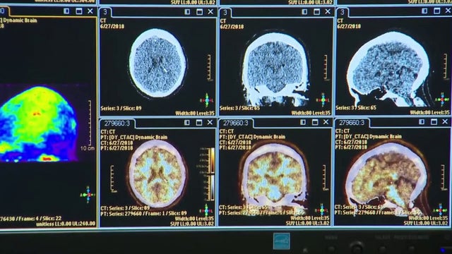 Mild Cognitive Impairment: About a condition few people understand