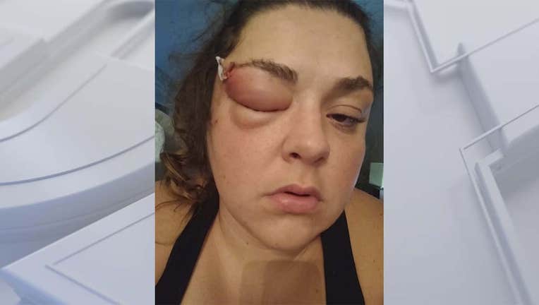 Ashley Settimi's swollen eyelid