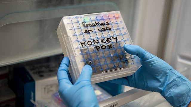 Minnesota reports first case of monkeypox