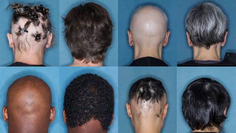FDA approves 1st drug treatment for alopecia hair loss
