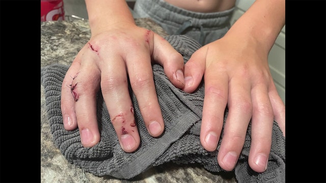 Isanti boy hospitalized after being bit by Anoka County K-9 dog