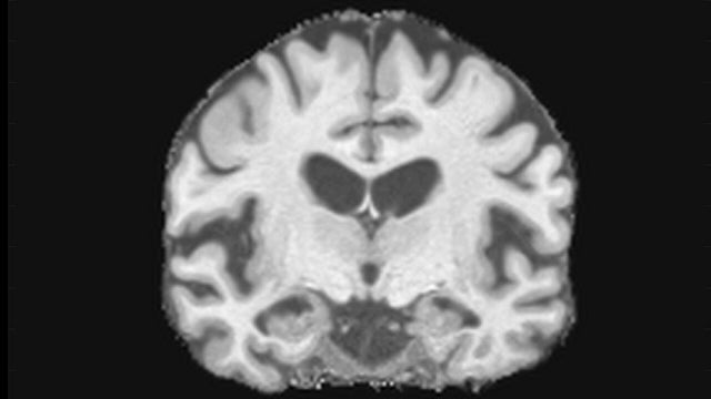 Alzheimer’s researchers find association between racism and memory loss