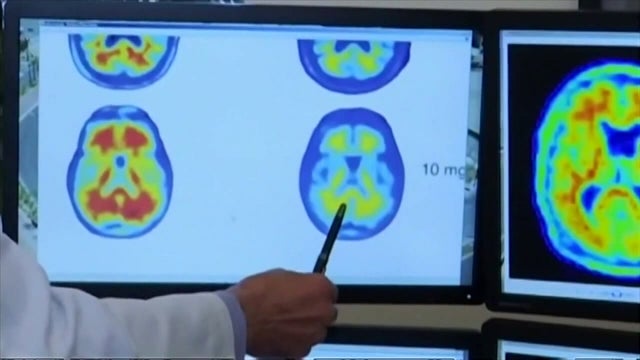 FDA considering accelerated approval of new Alzheimer’s drug