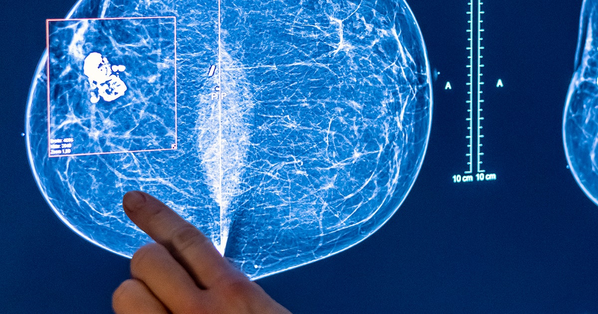 Artificial intelligence helping detect early signs of breast cancer in ...
