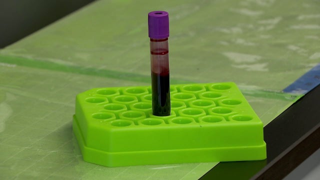 Allina Health Cancer Institute launches AI clinical trial for cancer detection