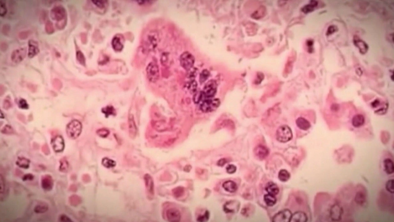 Measles exposure risk for anyone who visited Mall of America evening of May 24