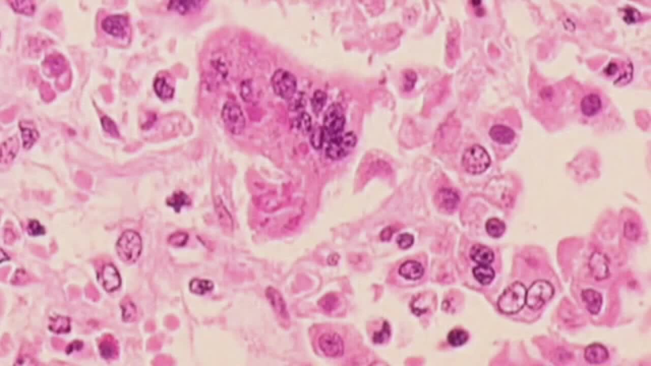 Measles in Wisconsin: New case confirmed in Marathon Co., 164 total cases as of Sept. 15