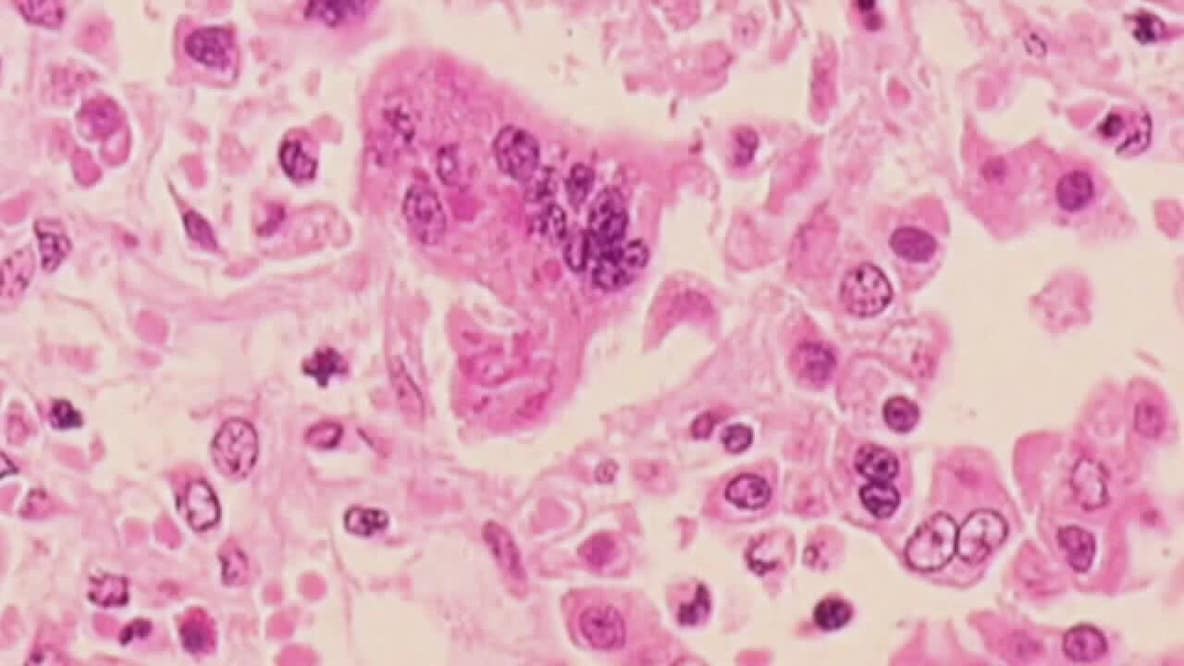 Measles in Wisconsin: New case confirmed in Marathon Co., 164 total cases as of Sept. 15