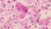 Measles in Wisconsin: New case confirmed in Marathon Co., 164 total cases as of Sept. 15