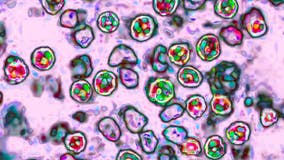 Wisconsin confirms first 9 measles cases of 2025, all linked to out-of-state travel