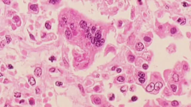 Possible measles exposure: Health officials warn of infected traveler