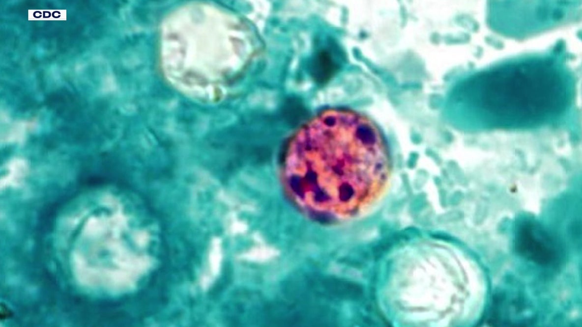 Cyclosporiasis in Minnesota: ‘Explosive diarrhea’ outbreaks being tracked by officials