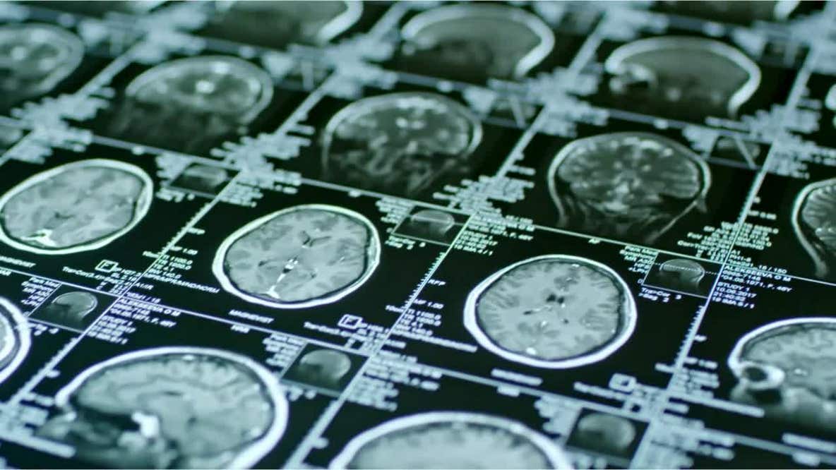 Walk for Thought 2025: Minnesota Brain Injury Alliance honors survivors at Long Lake Regional Park