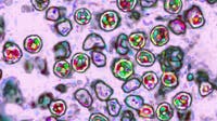 Measles in Wisconsin: Outbreak now has over 200 confirmed cases in Southwest Wisconsin