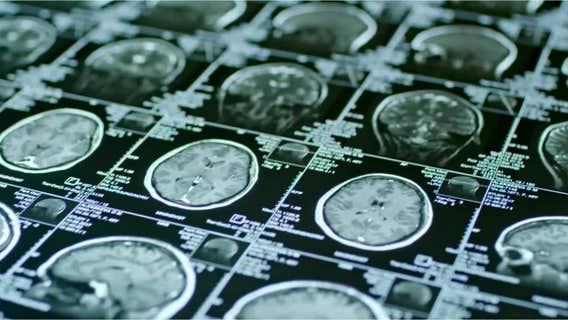 Walk for Thought 2025: Minnesota Brain Injury Alliance honors survivors at Long Lake Regional Park