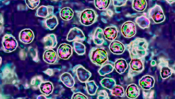 Measles in Wisconsin: 2 lab-confirmed cases in Vernon County