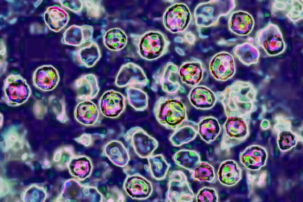 Measles in Wisconsin: 10 confirmed cases in Chippewa County