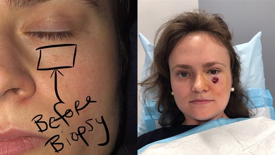 Woman, 24, recovering from skin cancer on face after she thought it was pimple