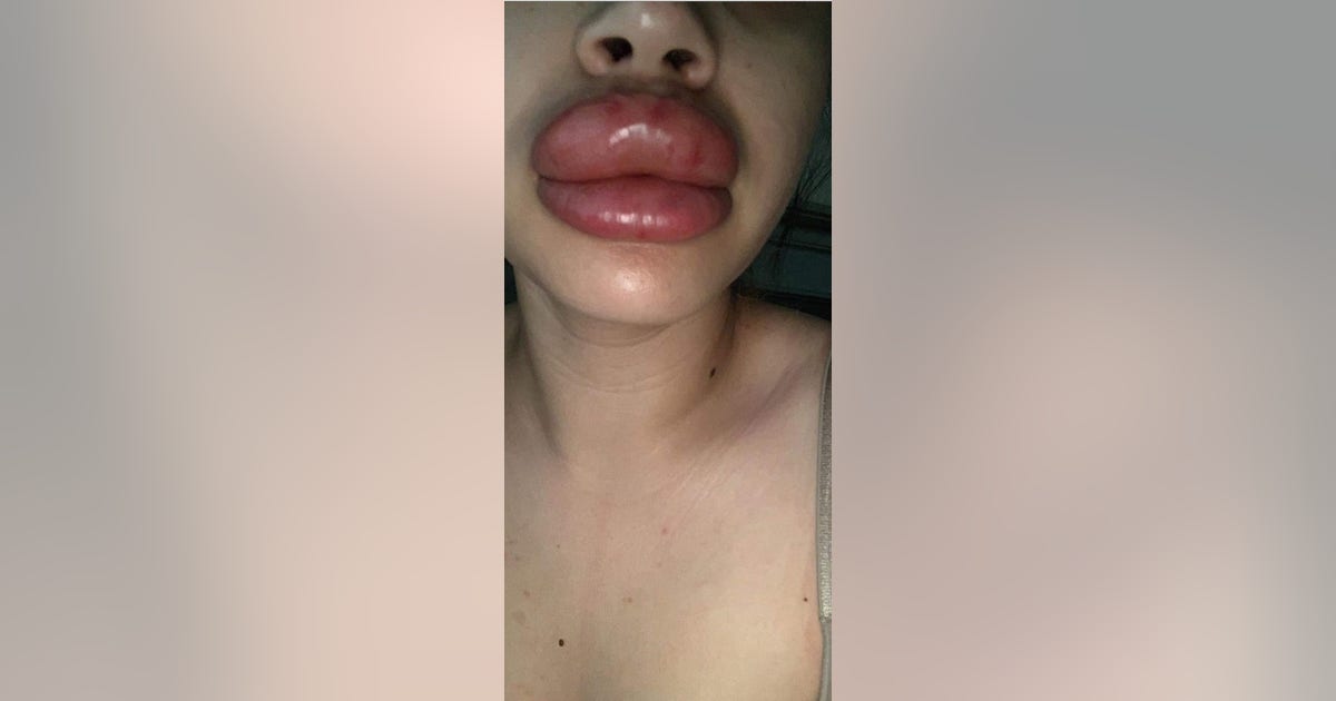 Valley women claim botched lip injections caused severe infection | FOX ...