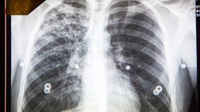 Student diagnosed with active tuberculosis, Public Heath warns of possible exposure at CSUSB