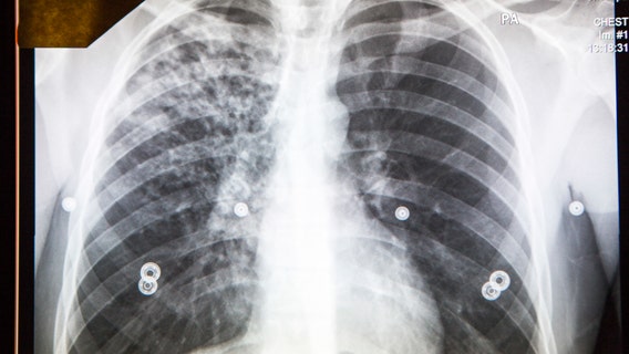 Student diagnosed with active tuberculosis, Public Heath warns of possible exposure at CSUSB