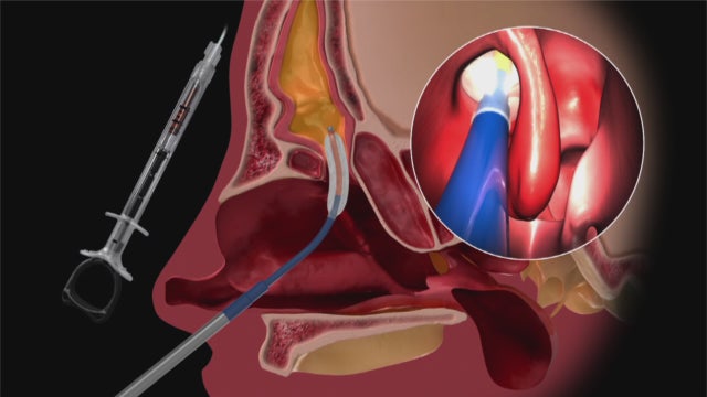 Innovative sinus balloon helps adults suffering from chronic sinusitis