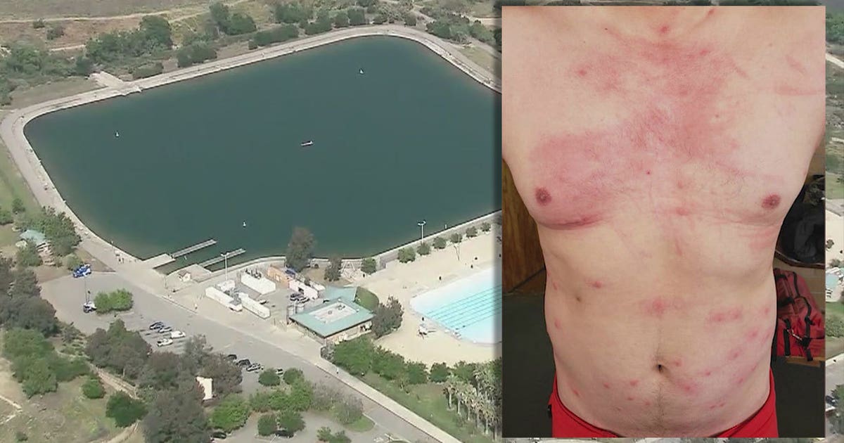 More than 20 L.A. lifeguards develop rash, respiratory problems ...
